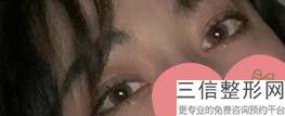 整容让眼睛变大怎么让眼睛变大,除了整容怎么才能让眼睛变大