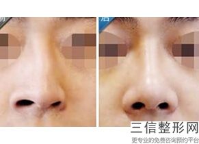 郑州鼻梁整形医院,河南郑州隆鼻医院