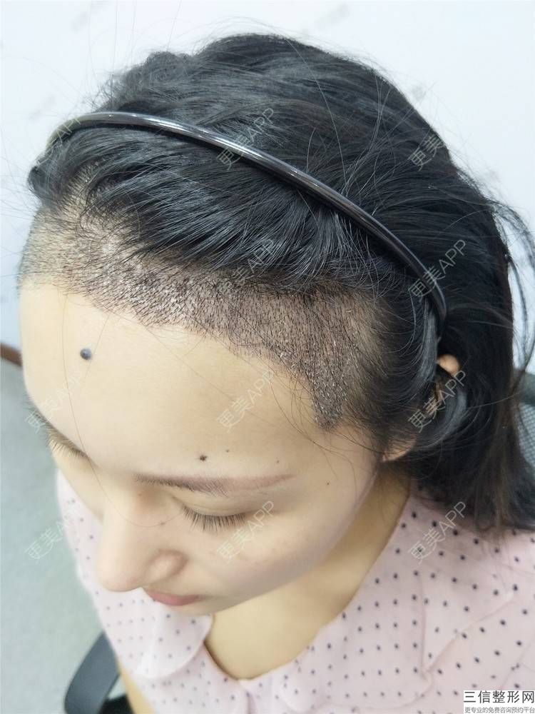 植眉可以提取眉毛毛囊吗,眉毛的毛囊可以植发吗