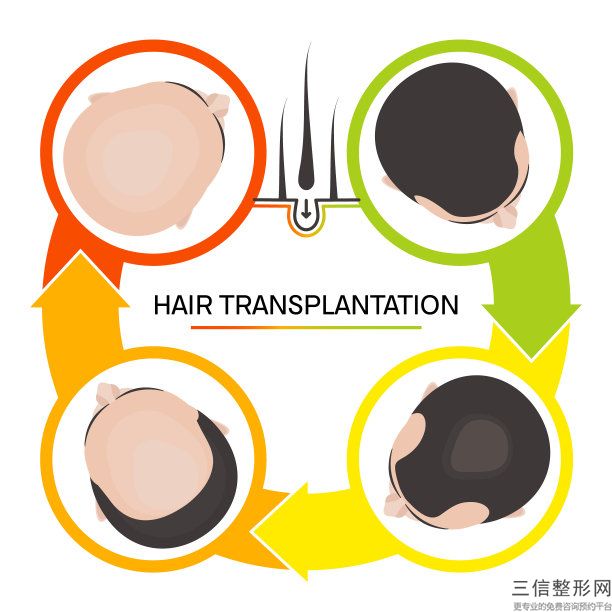 种发际线一根多少钱，植发际线要多少钱