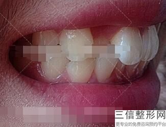 种植牙的后期养护,做了种植牙后应该怎么护理-