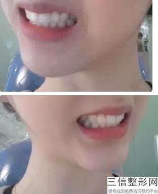 种植牙前需要做些什么准备工作，种植牙非常好步完成后注意什么