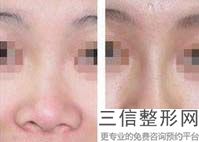 注射隆鼻多少钱啊，注射隆鼻大约多少钱