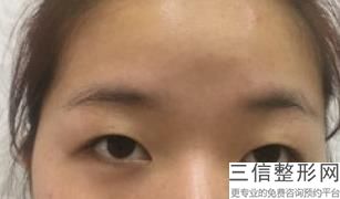 做过切开双眼皮还能再做吗，全切双眼皮加开眼角一般多久就恢复得差不多了