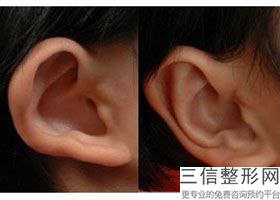 做过一次耳软骨隆鼻还能做耳软骨吗，耳软骨隆鼻是用自己的耳软骨吗