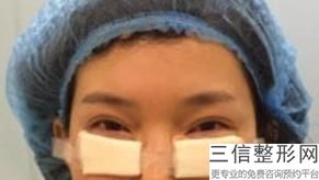 做了双眼皮多久能修复,双眼皮做完多长时间可以修复