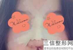 做隆鼻后悔的人多吗，隆鼻子有没有后遗症