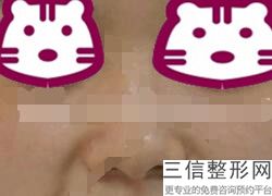 做歪鼻整形,歪鼻矫正医院哪家好