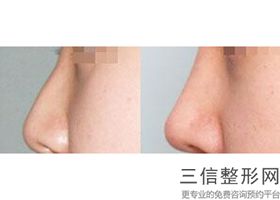 做歪鼻整形,歪鼻矫正医院哪家好