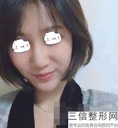 做完假体鼻子怎么快速消肿，假体隆鼻消肿过程