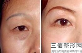 成都双眼皮手术医生排行榜,2022成都双眼皮医生排名不容错过