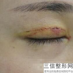 成都双眼皮修复医院前十位发布,2022 成都西区医院整形科实力上榜
