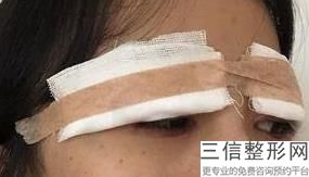成都双眼皮修复医院推荐排名前十,2022成都中医大银海眼科医院锁定前十
