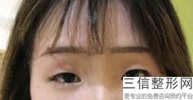 成都双眼皮做得好的医院排名推荐前四,2022口碑良好