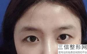 成都整形医院做双眼皮哪个医生好,2022卢尚兵医生锁定前十