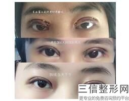 成都做眼部手术整形医院排行榜,2022成都军大整形医院口碑不错