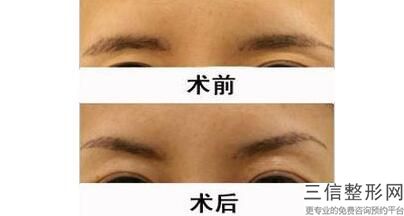 成都双眼皮手术医院排名前十,2022成都米兰柏羽医学美容医院位列前十