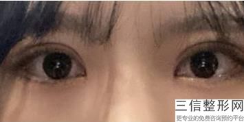 成都双眼皮修复手术医生排行榜前十,2022刘辅蓉实力超强