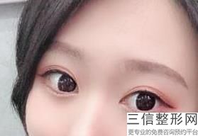 成都双眼皮整形医院排行前三的,2022成都圣丹福整形美容医院首次上榜