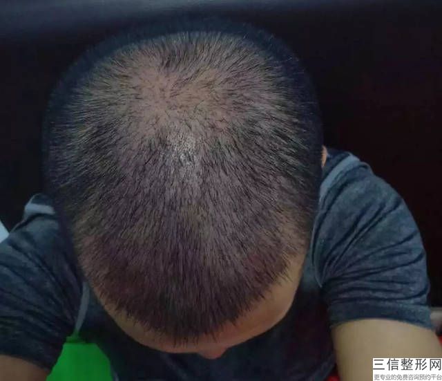 成都正规植发医院有哪些,2022成都恒博植发口碑不错
