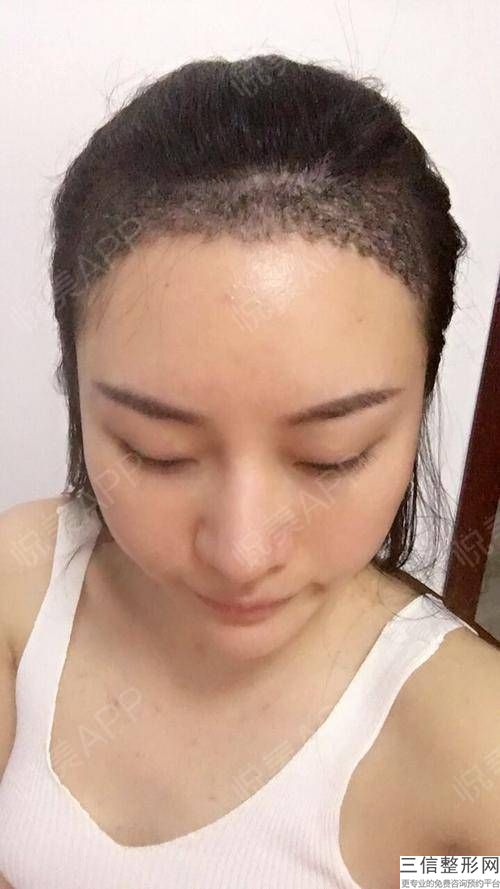 成都植发医院哪家好,2022成都恒博植发医院口碑良好