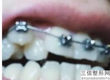 成都种植牙哪家医院比较好,2022成都极光口腔锁定前十