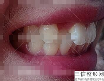 成都种植牙哪家医院比较好,2022成都市第一人民医院口腔科锁定前十