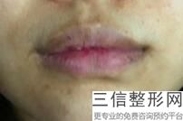 唇部整形排名前五,2022合肥台美丽格医疗美容锁定前十