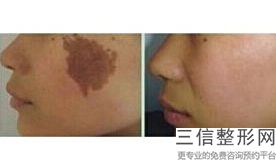 大拉皮手术上海哪家医院做的好,2022上海华美医疗美容医院实力超强
