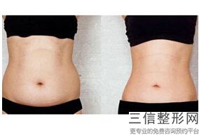 北京脂肪丰胸好的医院有哪些,2022北京大学第三医院整形科实力超强