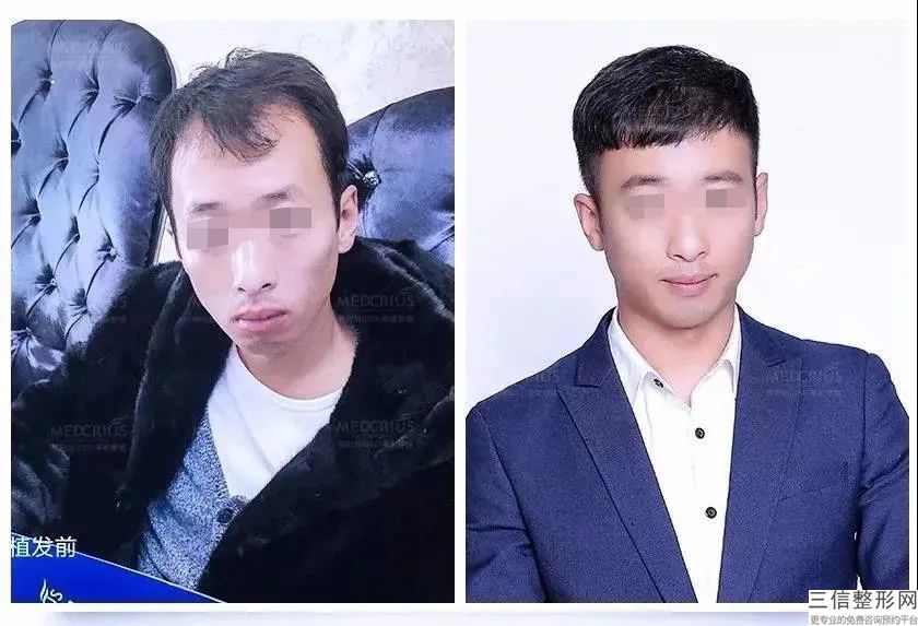 北京植发哪家医院好还实惠,2022北京植发门诊部实力上榜