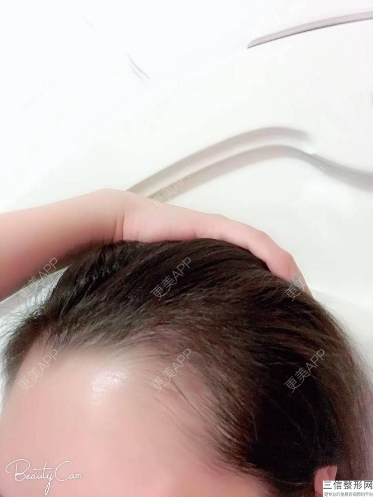 北京植发医院排名十强名单,2022北京高新毛发移植中心排名靠前