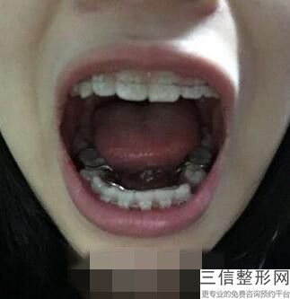北京种植牙好医院有哪几个,2022北京佳美口腔医院实力非凡
