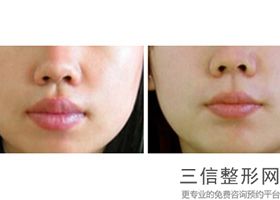 北京嘴唇整形医院哪家好,2022北京煤炭总医院整形外科锁定前十