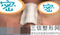 北京做鼻子好的专家前五排名,2022北京美莱牛永敢案例:首次上榜