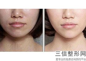 北京做拉皮手术哪里价格便宜果好,2022北京艾玛医疗美容医院实力非凡