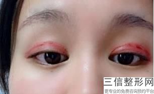北京做眼袋正规医院哪个好,2022北京叶子整形美容医院锁定前十
