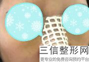 鼻部整形医生排名,2022薛志强医生遥遥领先
