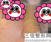 爱贝芙注射美容，爱贝芙注射隆鼻价格