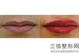 薄唇加厚手术过程，厚嘴唇变薄手术图片