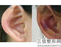 宝宝杯状耳是怎么形成的，杯状耳轻度