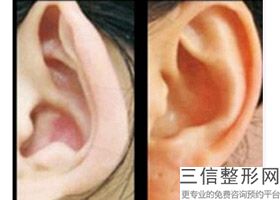 杯状耳整形多少钱，杯状耳术后效果图