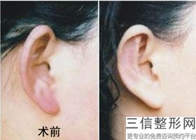 北京哪个医院可以打耳洞，正规医院打肉毒素多少钱