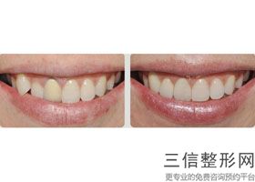 北京种植全口牙多少钱，北京牙齿种植价钱_1