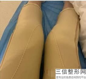 北京做假体隆胸哪家医院效果好，北京假体丰胸一般多少钱