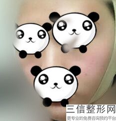 玻尿酸鼻唇沟多少钱，注射泪沟需要几支玻尿酸