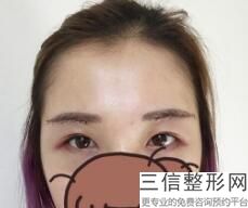 成人眼睛斜视不治疗会怎样，成人斜视是什么原因