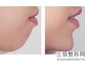 唇部整形要多少钱(唇部整形要多少钱？必须有一个性感女神)