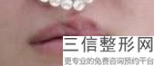 唇部整形有风险吗(做唇部整形需要注意什么)