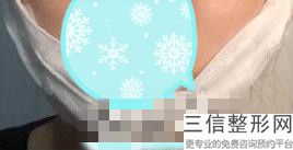 唇部整形有风险吗(做唇部整形需要注意什么)